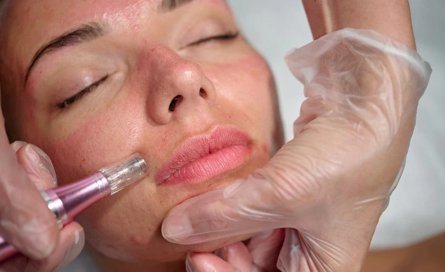 Soin PRP visage pour la régénération de la peau et l'amélioration du teint, effectué au cabinet médical du Dr. Hares à Larache.